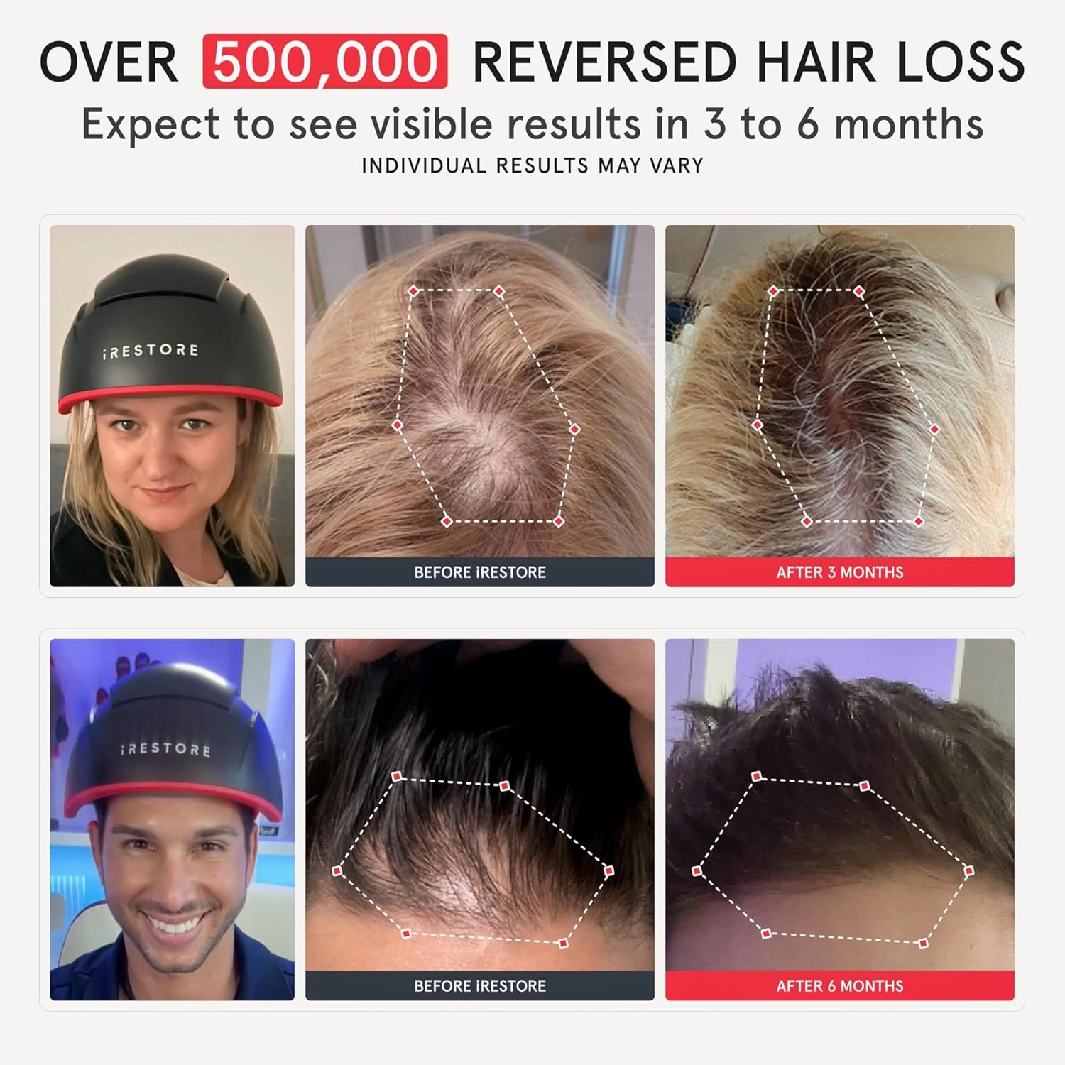 iRestore Elite   Rechargeable Battery Pack - Laser Red Light Therapy for Hair Growth - FDA Cleared Hair Loss, Hair Thinning Treatment for Men & Women - Hair Regrowth Laser Cap - 500 Lasers & LEDs